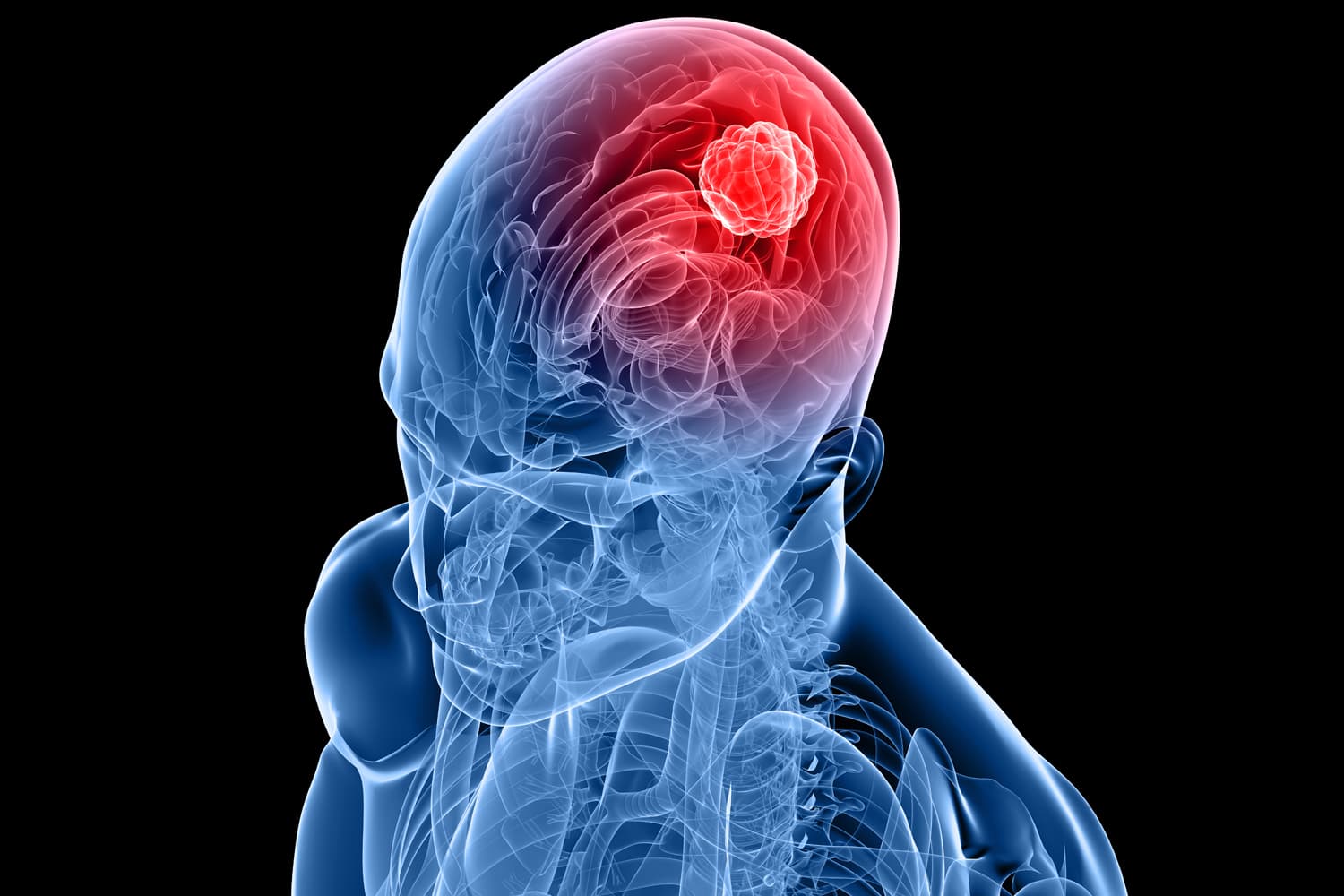 Brain & Spine - Radiation Oncology Care by Dr. Sarthak Kumar Mohanty in Rajkot, Gujarat
