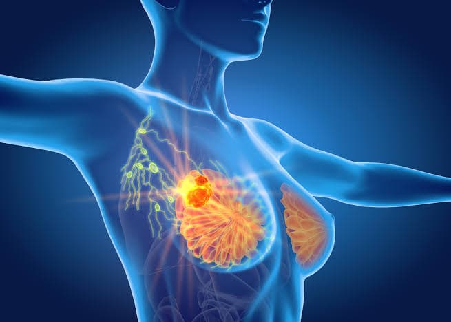 Breast Cancer - Radiation Oncology Care by Dr. Sarthak Kumar Mohanty in Rajkot, Gujarat