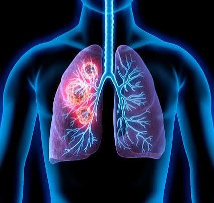 Thoracic - Radiation Oncology Care by Dr. Sarthak Kumar Mohanty in Rajkot, Gujarat