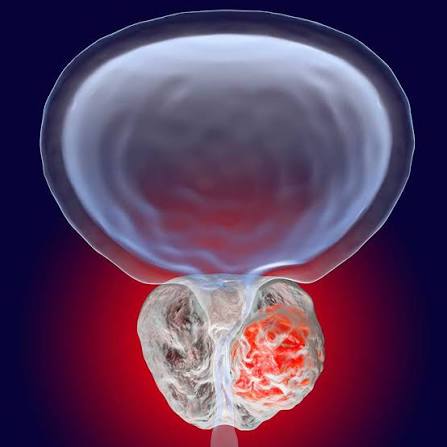 Genitourinary Cancers Radiotherapy Care